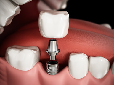 Dental Implant